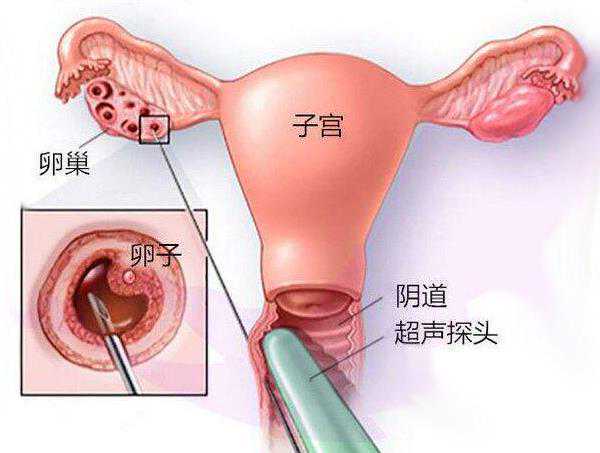 湖南公立医院供卵试管婴儿费用明细及医保报销政策